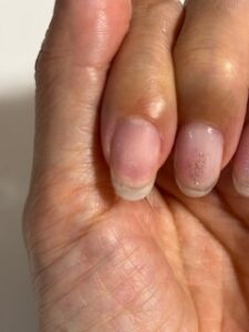 自爪人差し指ちょっと表面傷ついている